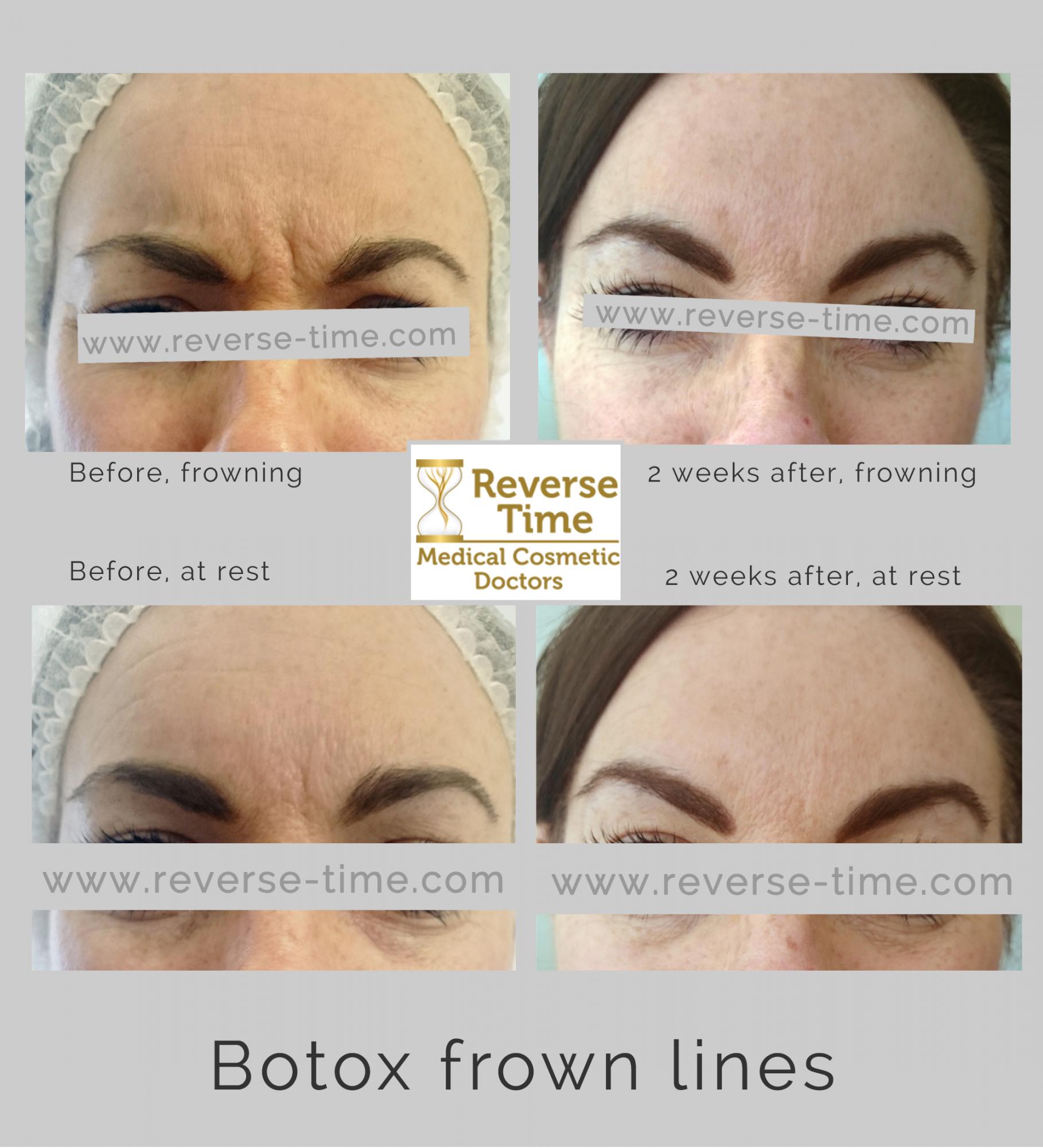 botox frown lines before after photos