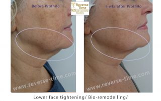 Profhilo lower face tightening