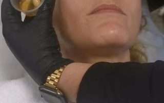 IMAGE Lightening Lift superficial Chemical Peel